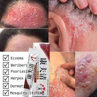 15g Natural Chinese Medicine Herbal Anti Bacteria Cream Psoriasis Eczema Ointment Skin Problem Repair Treatment Health Care