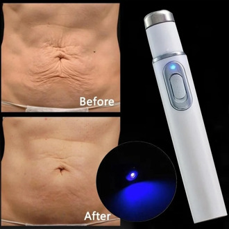 1pc Medical Blue Light Therapy Laser Pen Varicose Veins Treatment Soft Scar Wrinkle Removal Treatment Scar Acne Just 7 Days