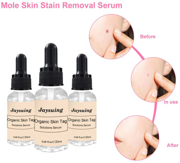 20ml Mole And Skin Tag Remover Liquid Genital Wart Treatment Papillomas Removal Of Warts Skin Tags Removing Against Moles