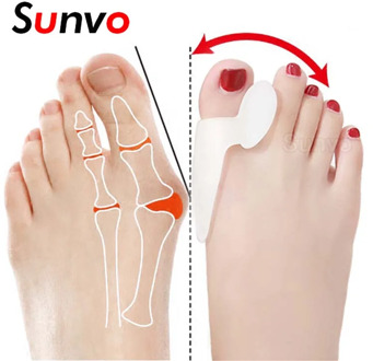 2Pcs Silicone Toe Separator Bunion Splint Hallux Valgus Orthosis Correction Overlapping Spreader Foot Protector Inserts