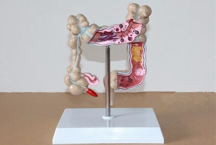 4D Levensgrote Human Colon Ziekte Model De Dikke Darm Pathologische Model Gastroenterology Aids Anatomisch Medische Schedel