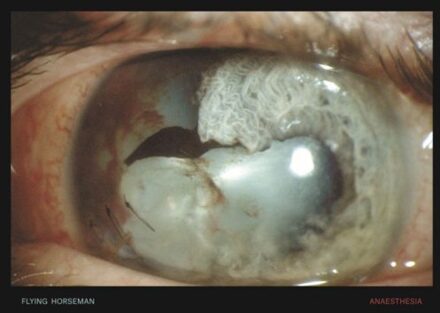 Anaesthesia - Flying Horseman