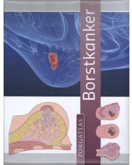 Borstkanker - Boek Maria Bruins (9491984225)
