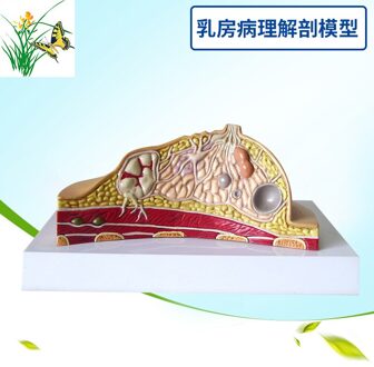 Borstkanker Borst Anatomie Model Menselijk Lichaam Model Anatomisch Menselijk Pathologische Borst Model Medische Ziekte & Kanker Anatomie