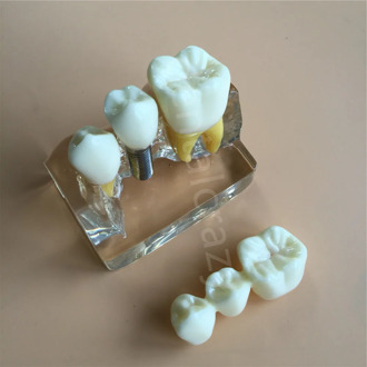 Clear Dental Demonstration Study Teeth Model for Implant Analysis Crown Bridge Model