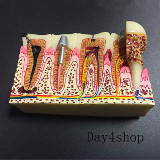 Dental Anatomy of dental caries plastic teeth model demonstration communication