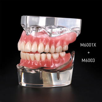 Dental Implant Restoration Teeth Model Removable Bridge Denture Demo Disease Teeth Model With Restoration Bridge Teaching Study
