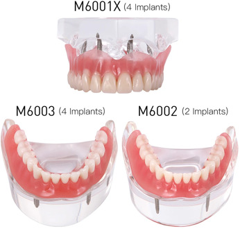 Dental Implant Teeth Model Removable Interior Mandibular Demo Overdenture With Implants upper/Lower for Tooth Teaching Study