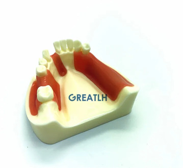 Dental Lower Jaw Implant Practice model Gingiva with missing teeth dentist educational dental school teeth practise model