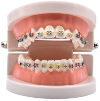 Dental Orthodontic Treatment Model With Ortho Metal Ceramic Bracket Arch Wire Buccal Tube Ligature Ties Dental Tools Dentist Lab