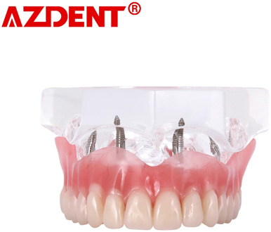 Dental Overdenture Teeth Dental Implant Teeth Model Demo Overdenture Restoration With Implants upper