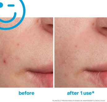 EradiKate Behandeling voor Oneffenheden 30 ml