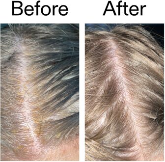 Exfoliërende HoofdhuidBehandeling met Salicylzuur 150 ml