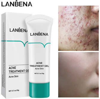 LANBENA Acne Removal Cream Acne Treatment Gel Remove Blackheads Pimples Face Clean Effective Fade Marks Scar Repair Damaged Skin