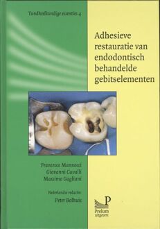 Prelum Uitgevers Adhesieve restauratie van endodontisch behandelde gebitselementen - Boek Francesco Mannocci (9085620589)
