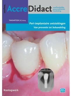 Prelum Uitgevers Peri-Implantaire Ontstekingen - Accredidact - Yvonne de Waal