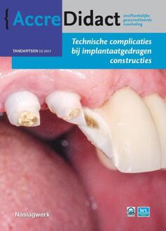 Prelum Uitgevers Technische complicaties bij implantaatgedragen constructies - Boek Gordon van der Avoort (9089762493)