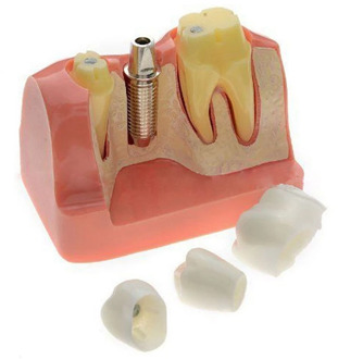 Professional Teeth Model Transparent Pathological Implant Nerve Model for Science Disease Teaching Study