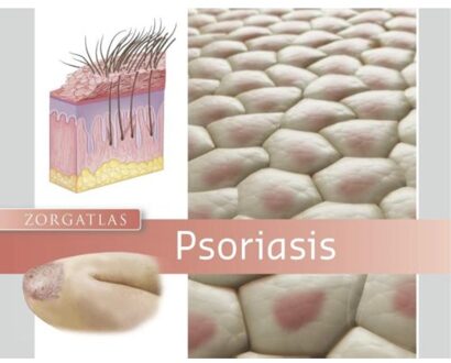 Psoriasis + Dry Erase Market met wisser - Boek R.C. Beljaards (9491984306)