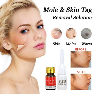 Removal Face Wart Tag Freckle Cream Removal Oil Mole Skin Tag Removal Solution Painless Mole Skin Dark Spot T