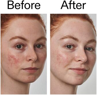 Super Solutions Serum 10% Azelaïnezuur 30 ml