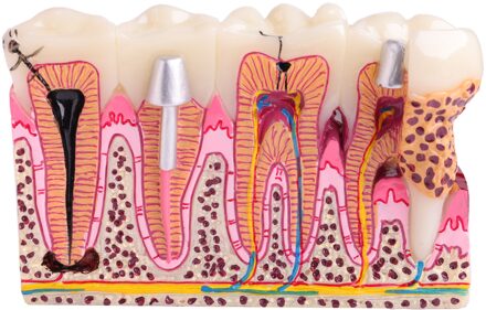 Tandheelkundige Anatomie Van Cariës Tanden Model Demonstratie M4029 Planten Pathologische Display Model