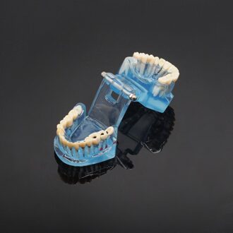 Tandheelkundige Kliniek Studie Tand Model Adult Pathologische Onderwijs Tanden Model Cariës