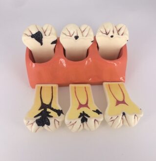 Tandheelkundige model 4 keer Cariës afbraak model Arts-patiënt communicatie model