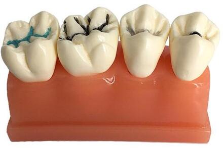 Tandheelkundige orale onderwijs model tandarts arts-patiënt communicatie tand model 3 keer pit en groef gesloten model