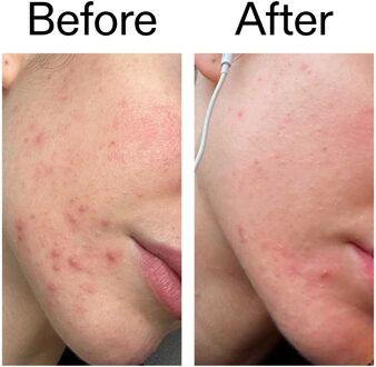 Vlekverwijderende Moisturizer 2% NovoRetin 50 ml