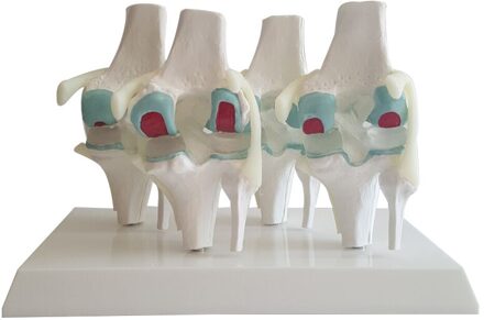 Zieke Kniegewricht Model Pathologie Knie Model Perverse Vier Stadia Kniegewricht Skelet Onderwijs Model